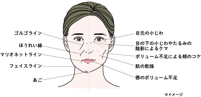 ヒアルロン酸注射でアプローチできる部位はゴルゴライン、ほうれい線、マリオネットライン、フェイスライン、あご、目の下の小じわやたるみの陰影によるクマ、ボリューム不足による頬のコケ、肌の乾燥、唇のボリューム不足
