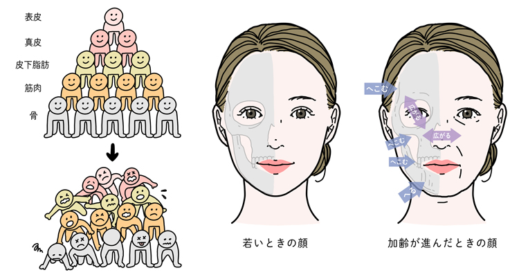 加齢による骨の変化によって顔のたるみが生じる