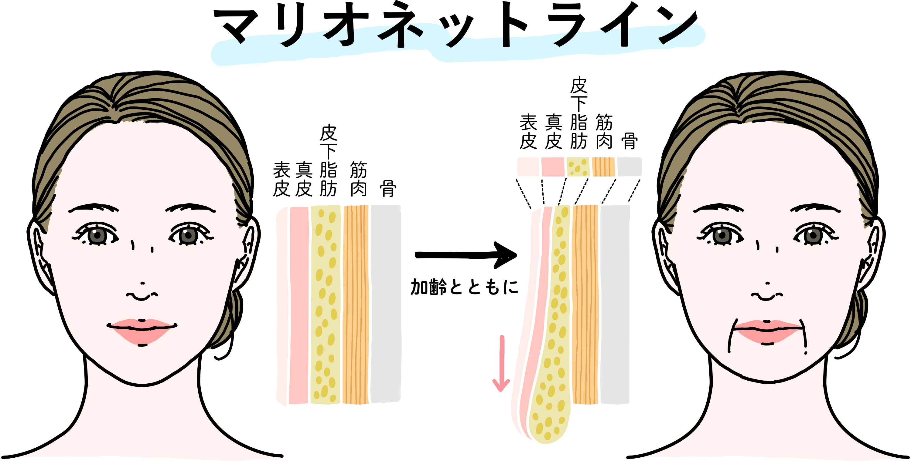 口の側部にできるマリオネットライン