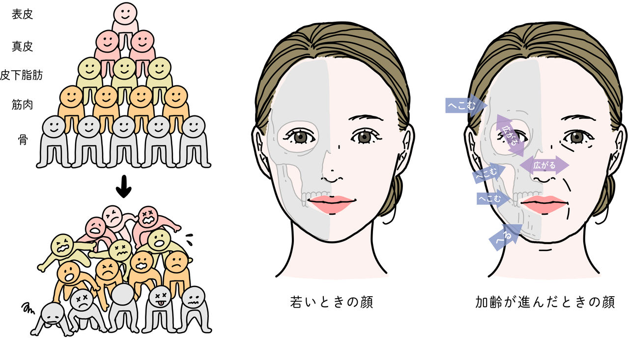 加齢とともに骨密度が減少し、へこみや広がりが起こるイメージ