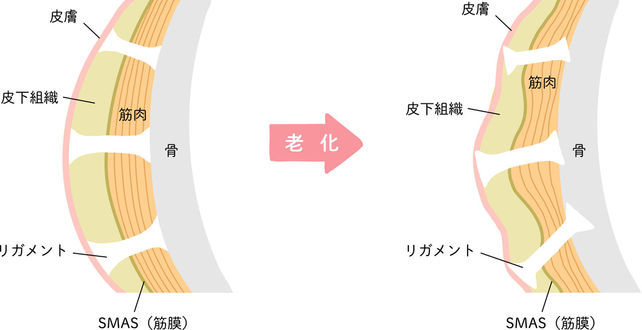 支持靭帯（リガメント）とSMAS（スマス）が衰えることでたるみにつながる